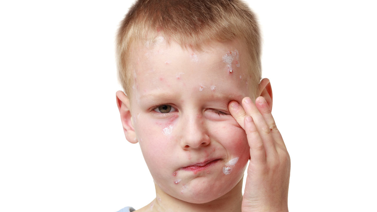 boy-with-chickenpox