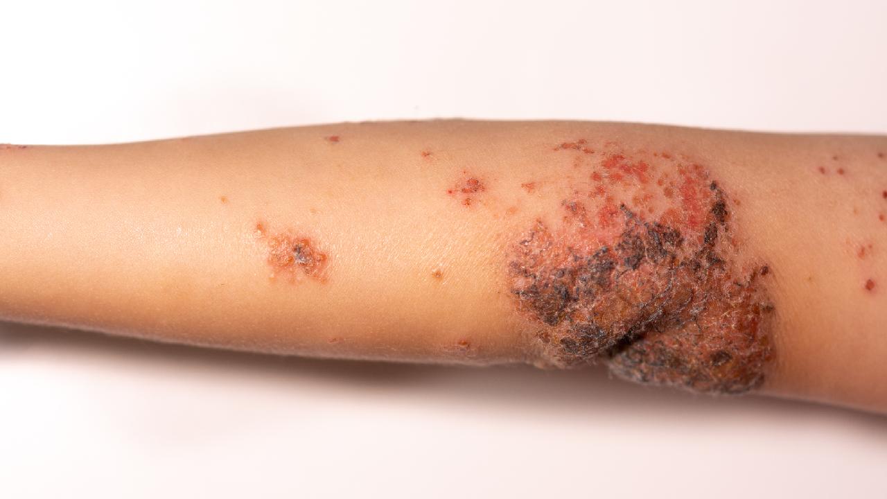 impetigo-arm-summary